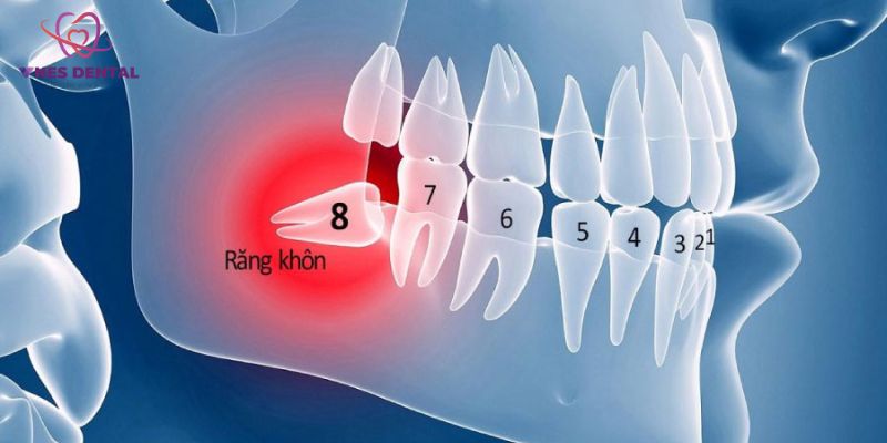 Có nên nhổ răng khôn không?