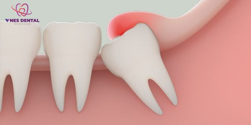 Một số lưu ý cần nhớ sau khi nhổ răng khôn